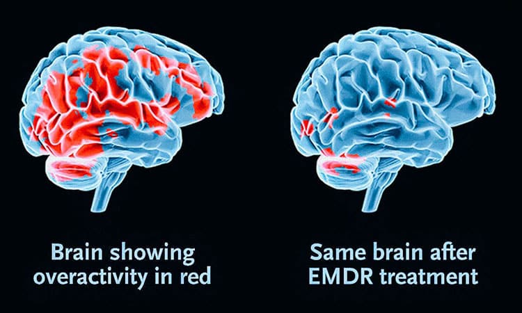 EMDR-Therapy